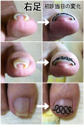 完全に指のお肉をつまんだ形になっているので、指に縦にシワがよっていました。ツメフラによって爪が開いた瞬間から血流の改善も始まります！